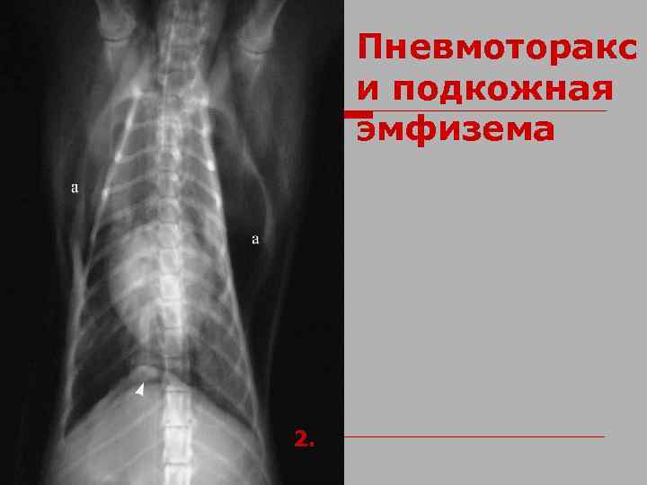 Пневмоторакс и подкожная эмфизема 2. 