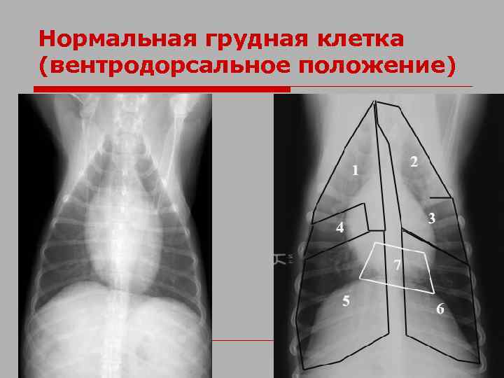 Нормальная грудная клетка (вентродорсальное положение) 