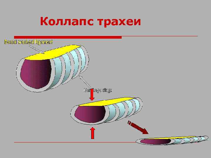 Коллапс трахеи 