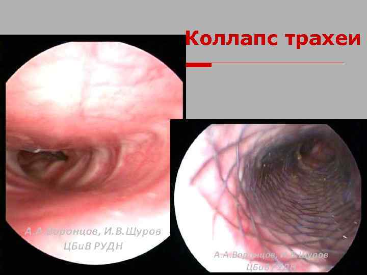 Коллапс трахеи 