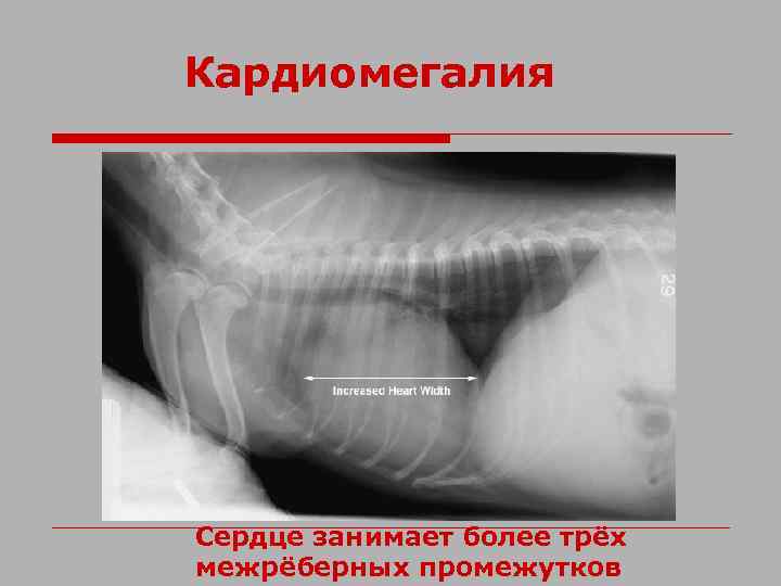 Кардиомегалия Сердце занимает более трёх межрёберных промежутков 