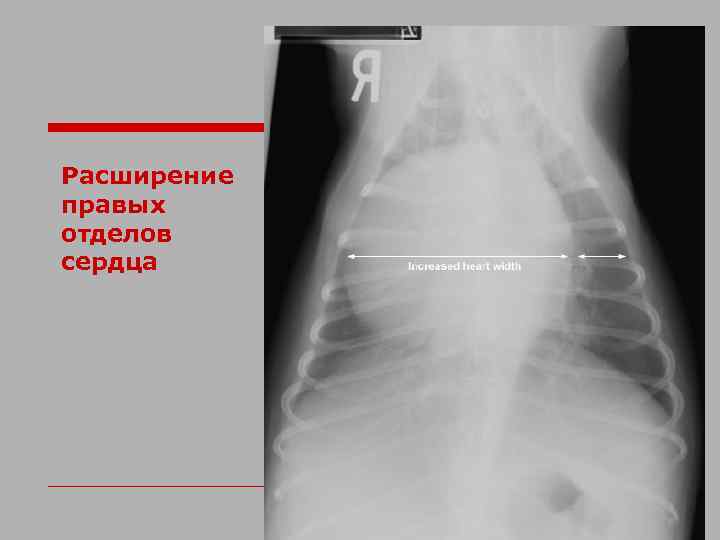 Расширение правых отделов сердца 