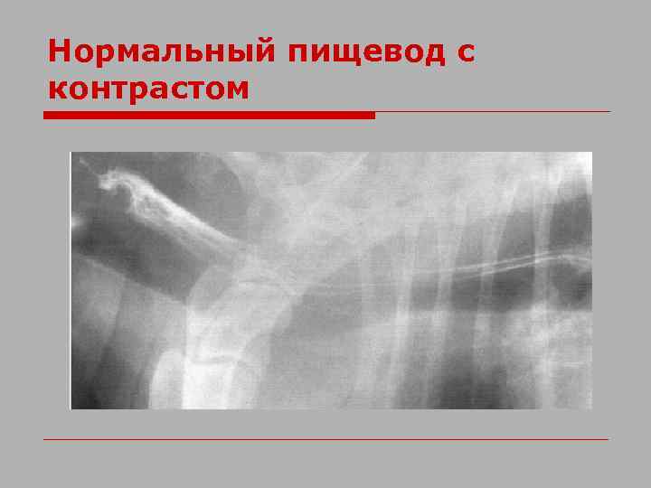 Нормальный пищевод с контрастом 