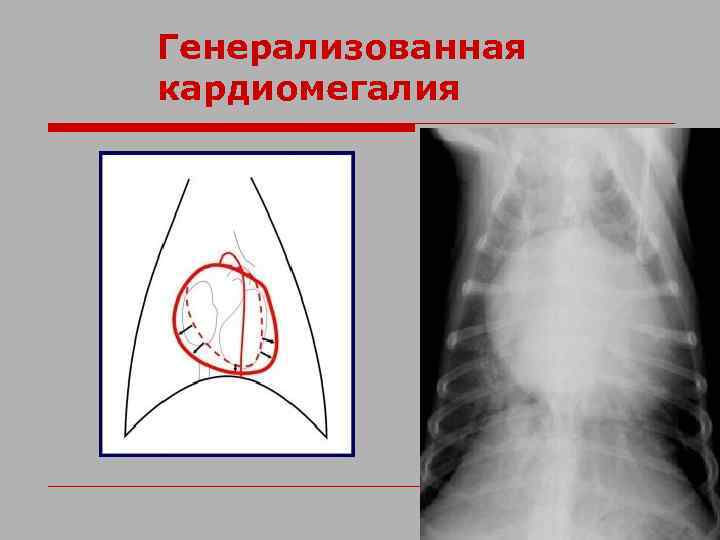 Генерализованная кардиомегалия 