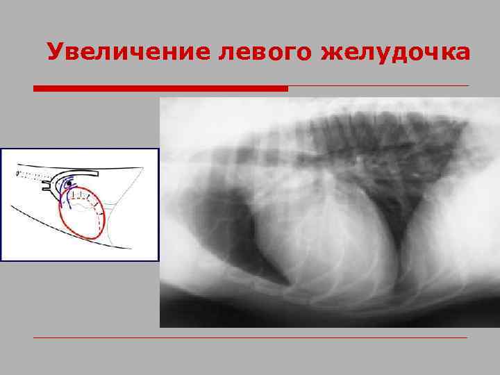 Увеличение левого желудочка 