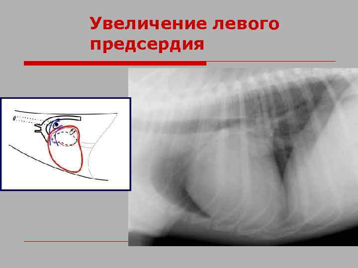 Увеличение левого предсердия 