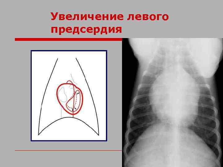 Увеличение левого предсердия 