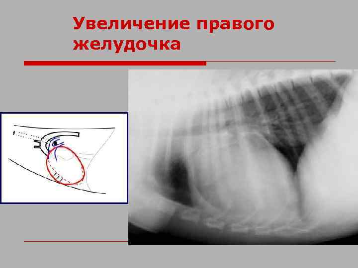 Увеличение правого желудочка 