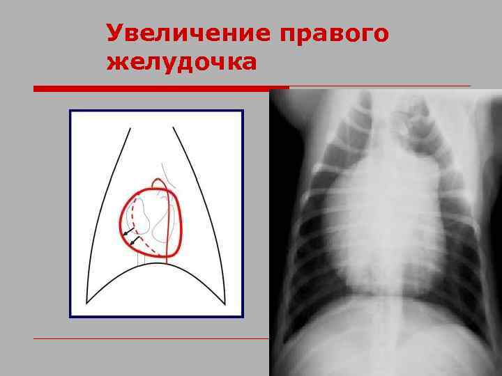 Увеличение правого желудочка 