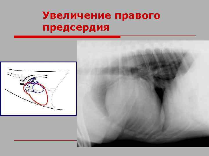 Увеличение правого предсердия 