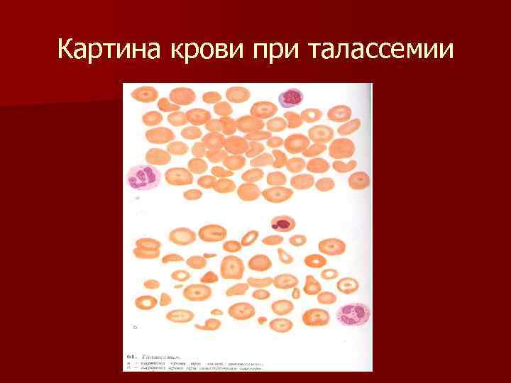 Картина крови при талассемии