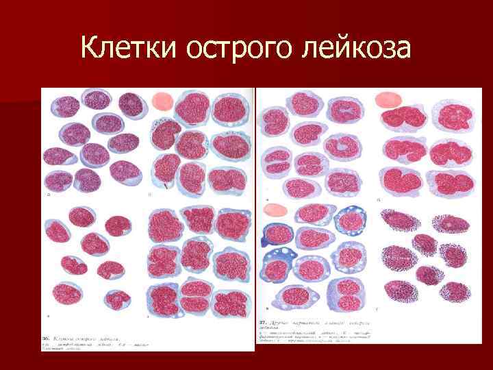 Клетки острого лейкоза 