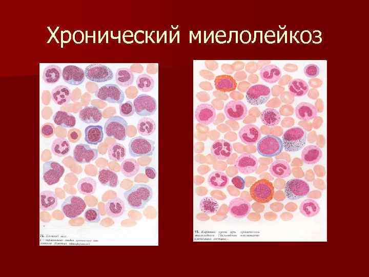 Миелолейкоз. Хронический миелолейкоз микроскоп. Хронический миелобластный лейкоз. Хронический миелобластный лейкоз картина крови.