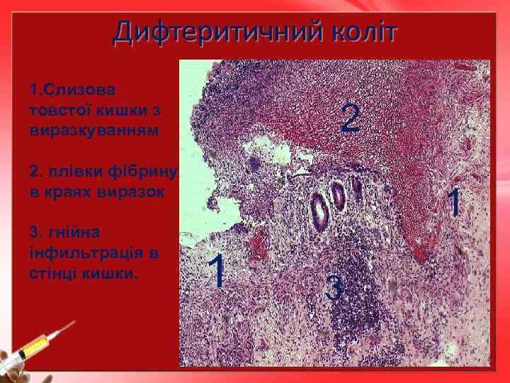 Дифтеритичний коліт 1. Слизова товстої кишки з виразкуванням 2 2. плівки фібрину в краях