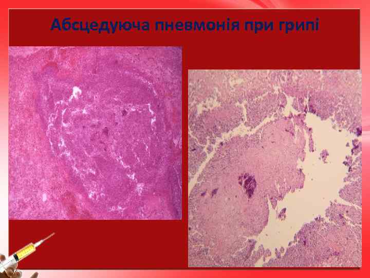 Абсцедуюча пневмонія при грипі 