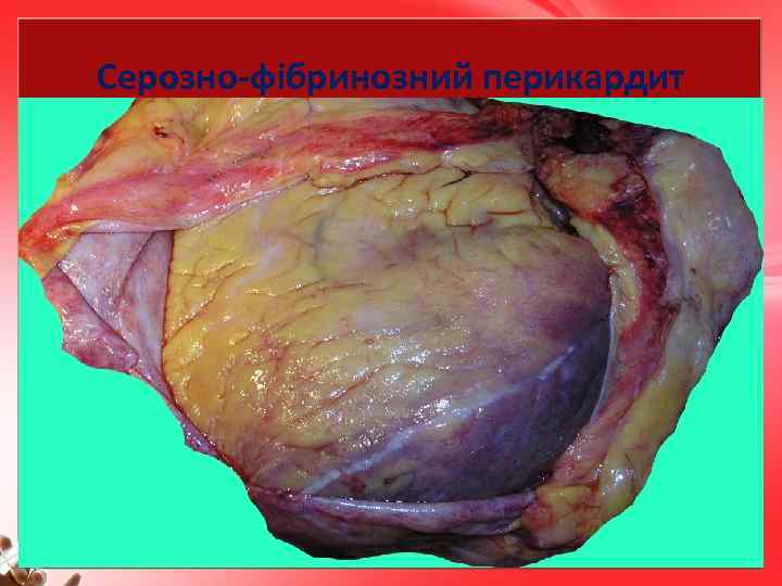 Серозно-фібринозний перикардит 