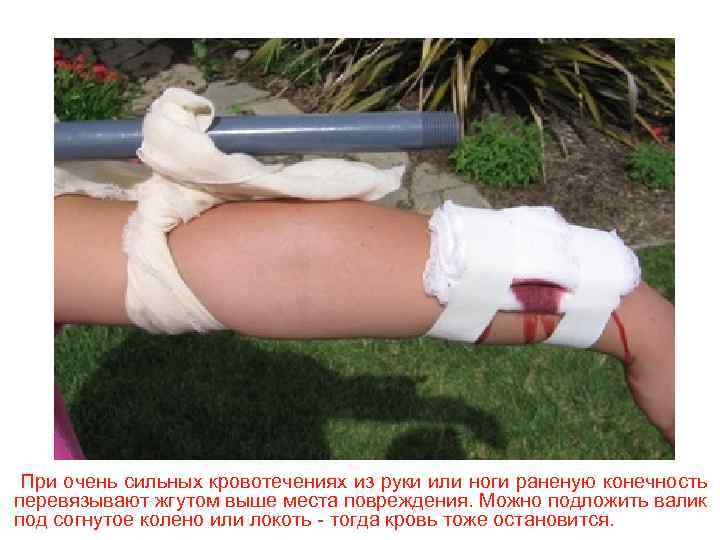 При очень сильных кровотечениях из руки или ноги раненую конечность перевязывают жгутом выше места