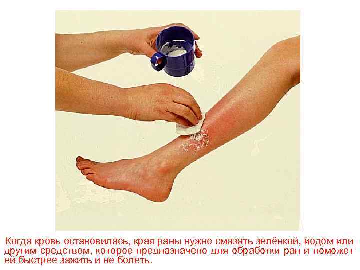 Когда кровь остановилась, края раны нужно смазать зелёнкой, йодом или другим средством, которое предназначено