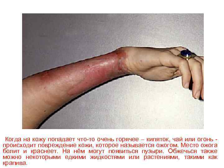 Когда на кожу попадает что-то очень горячее – кипяток, чай или огонь происходит повреждение