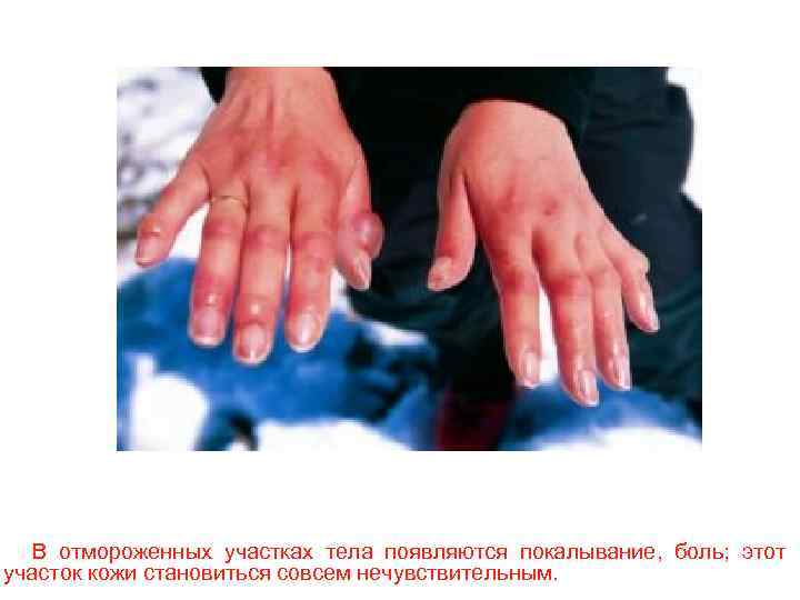 В отмороженных участках тела появляются покалывание, боль; этот участок кожи становиться совсем нечувствительным. 