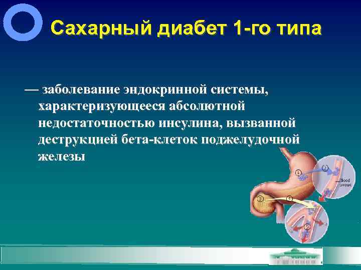 Сахарный диабет 1 -го типа — заболевание эндокринной системы, характеризующееся абсолютной недостаточностью инсулина, вызванной