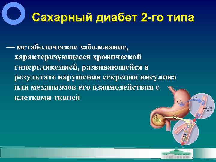 Сахарный диабет 2 -го типа — метаболическое заболевание, характеризующееся хронической гипергликемией, развивающейся в результате