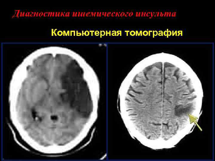 Диагностика ишемического инсульта Компьютерная томография 