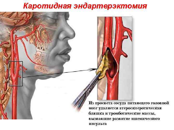 Каротидная эндартерэктомия Из просвета сосуда питающего головной мозг удаляется атеросклеротическая бляшка и тромботические массы,