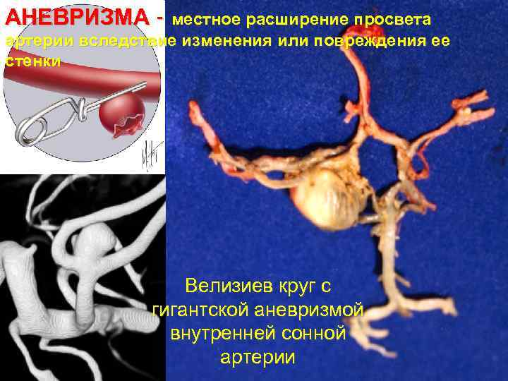 АНЕВРИЗМА - местное расширение просвета артерии вследствие изменения или повреждения ее стенки Велизиев круг