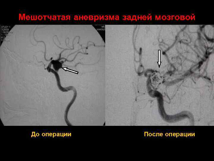 Мешотчатая аневризма задней мозговой артерии слева До операции После операции 