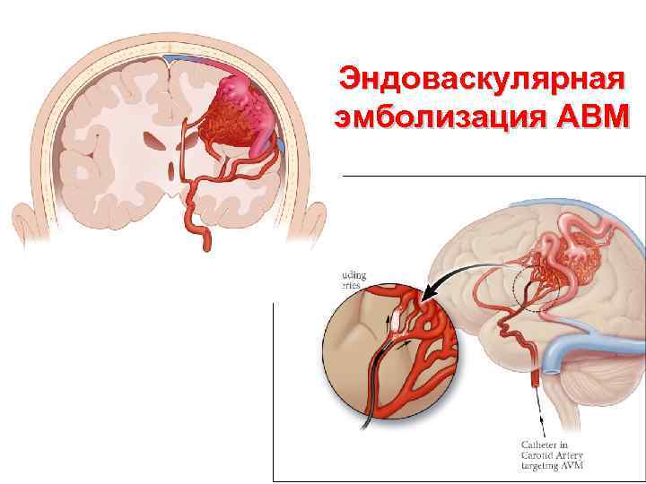 Эндоваскулярная эмболизация АВМ 
