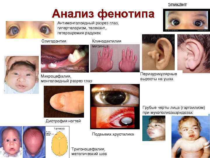 Анализ фенотипа эпикант Антимонголоидный разрез глаз, гипертелоризм, телекант, гетерохромия радужек Клинодактилия мизинца Олигодонтия Периаурикулярные