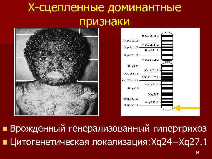 Х-сцепленные доминантные признаки n Врожденный генерализованный гипертрихоз n Цитогенетическая локализация: Xq 24−Xq 27. 1