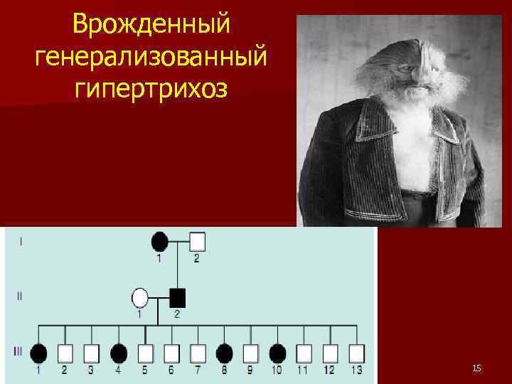 Врожденный генерализованный гипертрихоз 15 