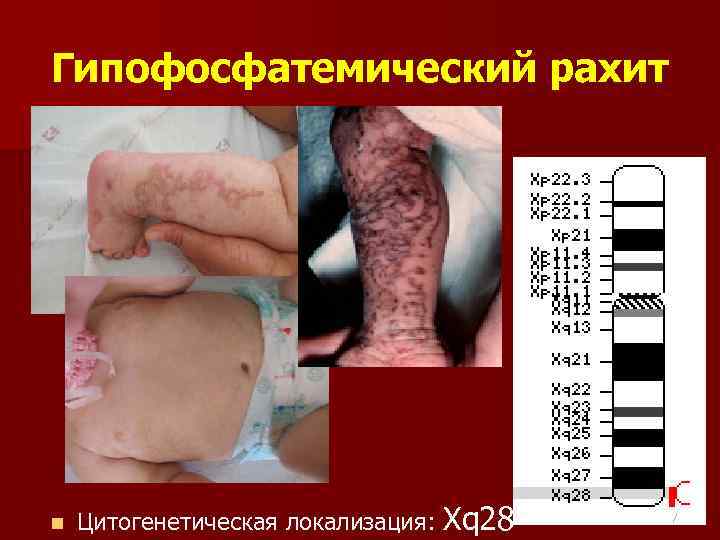 Гипофосфатемический рахит n Цитогенетическая локализация: Xq 28 17 
