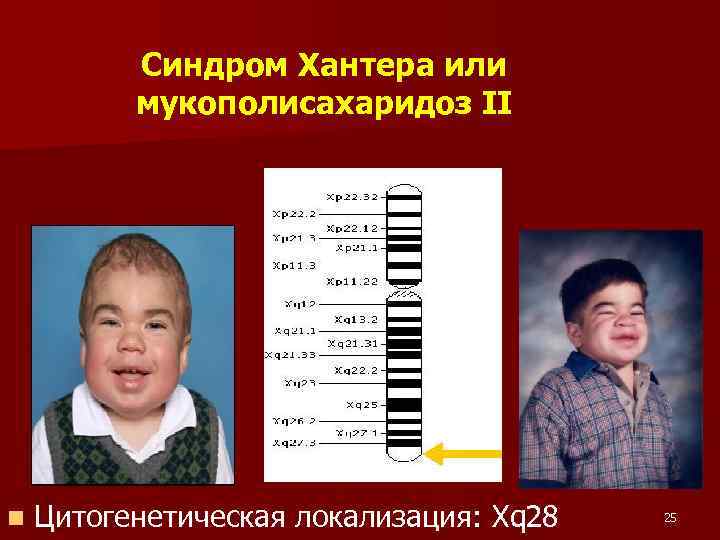 Синдром Хантера или мукополисахаридоз II n Цитогенетическая локализация: Xq 28 25 