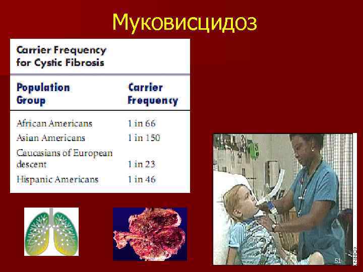 Муковисцидоз 51 51 