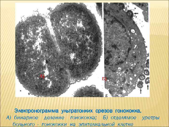 А) Б) Электронограмма ультратонких срезов гонококка. А) бинарное деление гонококка; Б) отделямое уретры больного