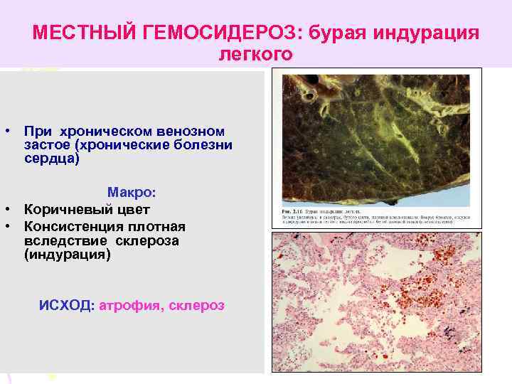 МЕСТНЫЙ ГЕМОСИДЕРОЗ: бурая индурация легкого • При хроническом венозном застое (хронические болезни сердца) Макро: