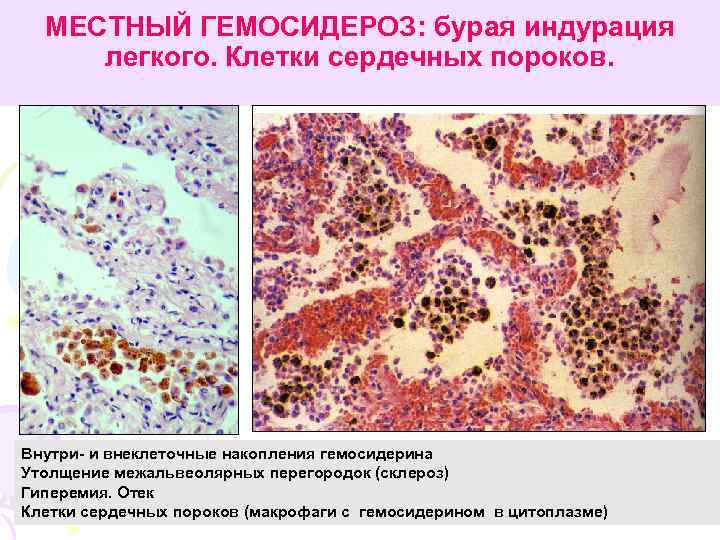 МЕСТНЫЙ ГЕМОСИДЕРОЗ: бурая индурация легкого. Клетки сердечных пороков. Внутри- и внеклеточные накопления гемосидерина Утолщение
