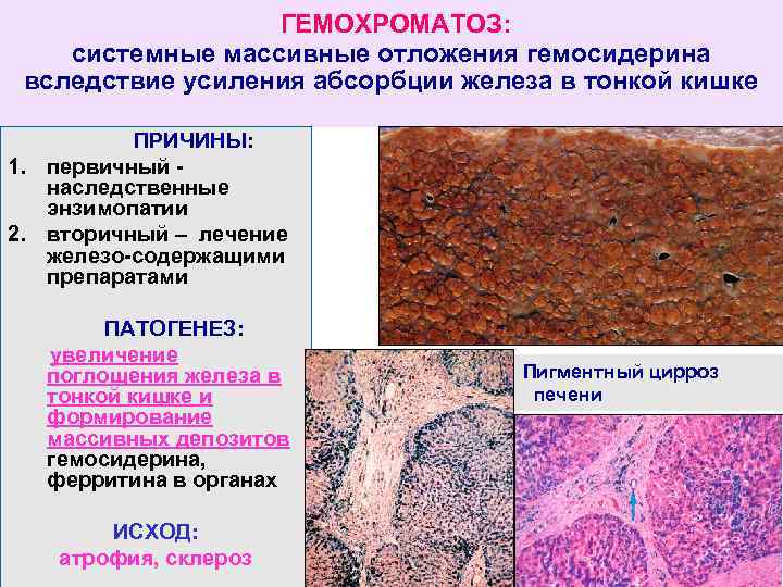ГЕМОХРОМАТОЗ: системные массивные отложения гемосидерина вследствие усиления абсорбции железа в тонкой кишке ПРИЧИНЫ: 1.
