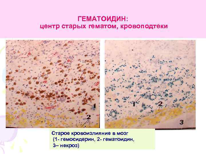 ГЕМАТОИДИН: центр старых гематом, кровоподтеки Старое кровоизлияние в мозг (1 - гемосидерин, 2 -