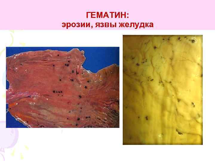 ГЕМАТИН: эрозии, язвы желудка 