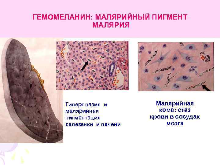 ГЕМОМЕЛАНИН: МАЛЯРИЙНЫЙ ПИГМЕНТ МАЛЯРИЯ Гиперплазия и малярийная пигментация селезенки и печени Малярийная кома: стаз