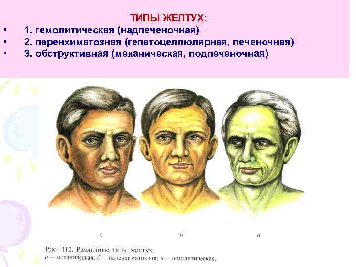  • • • ТИПЫ ЖЕЛТУХ: 1. гемолитическая (надпеченочная) 2. паренхиматозная (гепатоцеллюлярная, печеночная) 3.