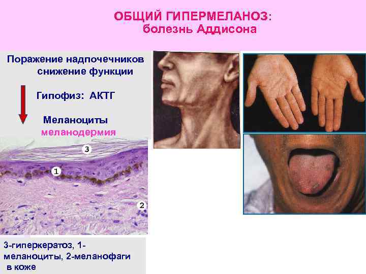 ОБЩИЙ ГИПЕРМЕЛАНОЗ: болезнь Аддисона Поражение надпочечников снижение функции Гипофиз: АКТГ Меланоциты меланодермия 3 -гиперкератоз,