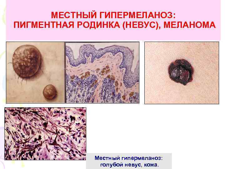 МЕСТНЫЙ ГИПЕРМЕЛАНОЗ: ПИГМЕНТНАЯ РОДИНКА (НЕВУС), МЕЛАНОМА Местный гипермеланоз: голубой невус, кожа. 