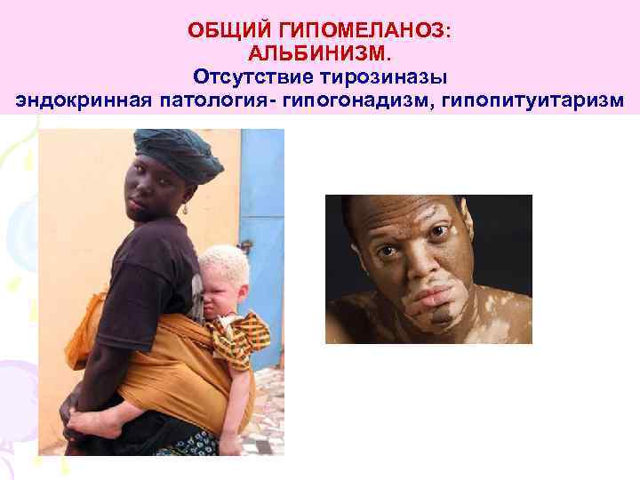 ОБЩИЙ ГИПОМЕЛАНОЗ: АЛЬБИНИЗМ. Отсутствие тирозиназы эндокринная патология- гипогонадизм, гипопитуитаризм 