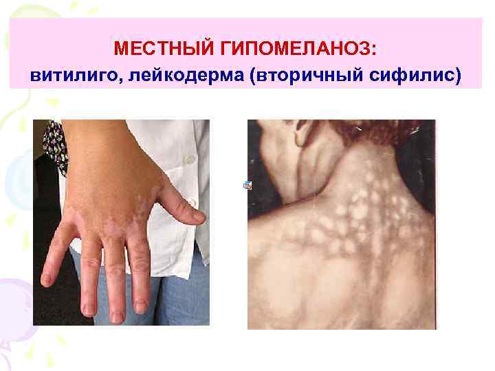 МЕСТНЫЙ ГИПОМЕЛАНОЗ: витилиго, лейкодерма (вторичный сифилис) 