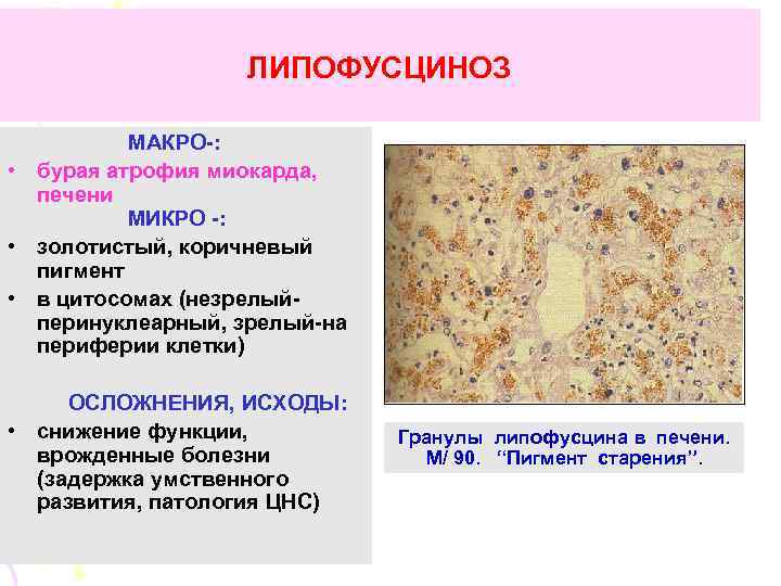 ЛИПОФУСЦИНОЗ МАКРО-: • бурая атрофия миокарда, печени МИКРО -: • золотистый, коричневый пигмент •